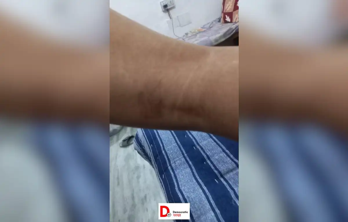 बंदरों के काटने के बाद कई बीमारियों का ख़तरा होता है